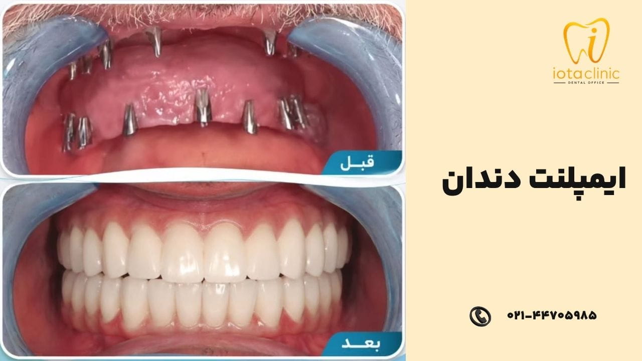 ایمپلنت دندان