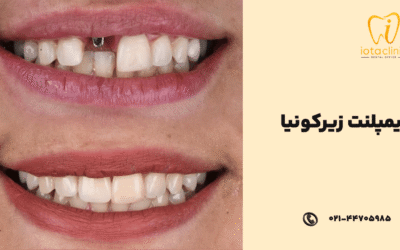 ایمپلنت زیرکونیا چیست؟ مزایا، معایب، کاشت و هزینه