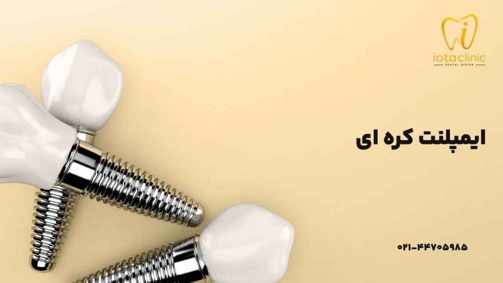 ایمپلنت کره ای