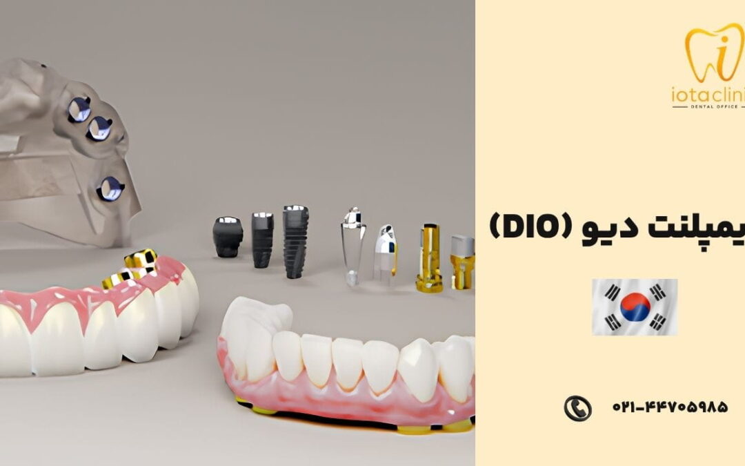 ایمپلنت دیو (DIO) کره ای: مزایا، معایب، قیمت و مشخصات